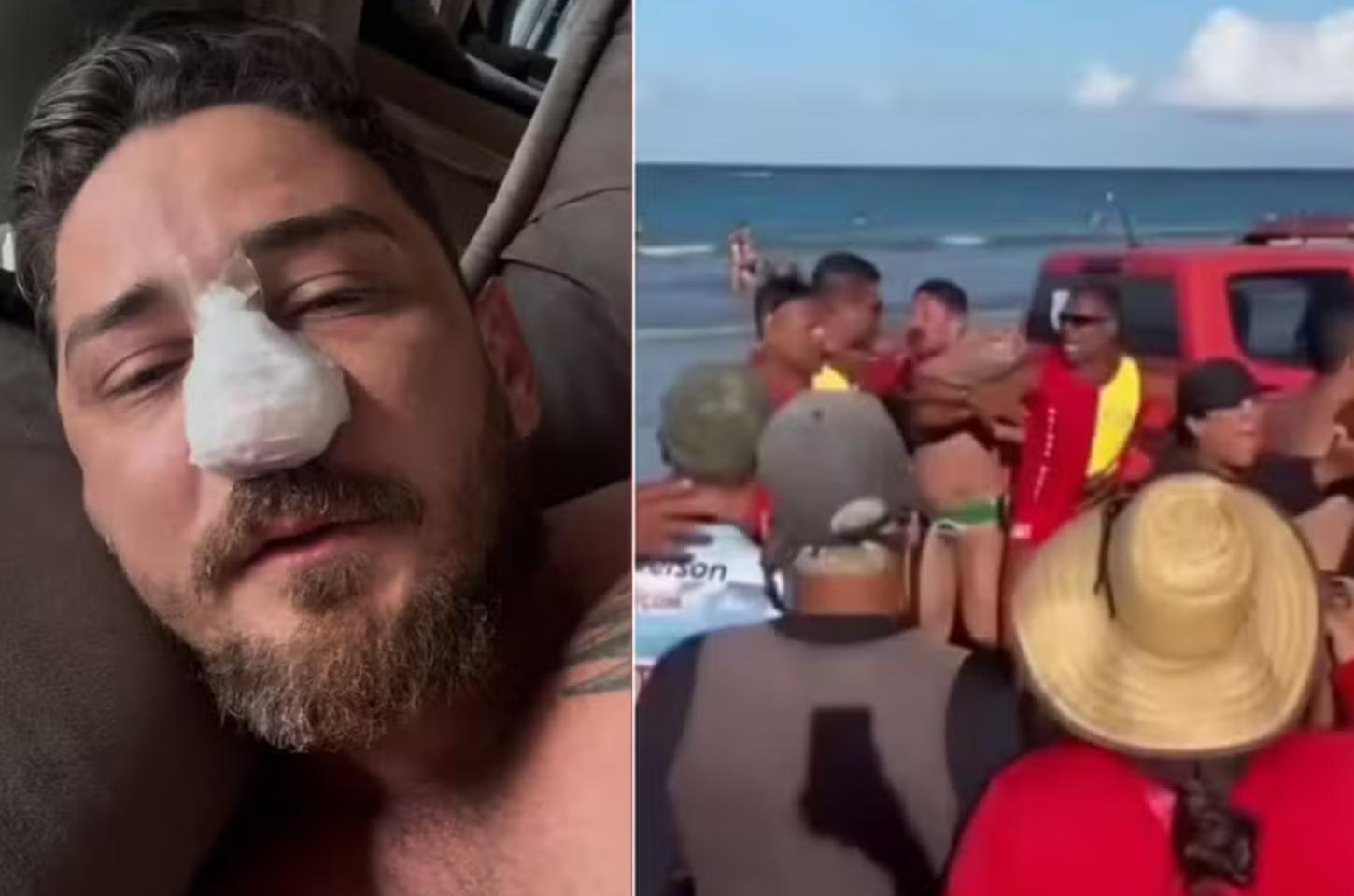 Agredido em Porto de Galinhas passa por cirurgia em MT após identificar 4 fraturas no rosto