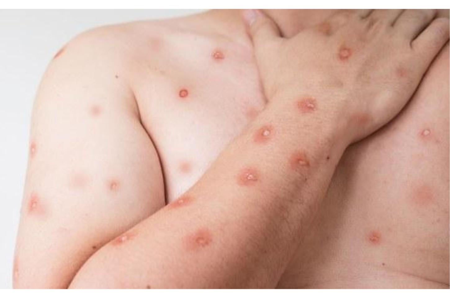 SES alerta para monitoramento de casos de Mpox em MT após avanço de variante em Rondônia